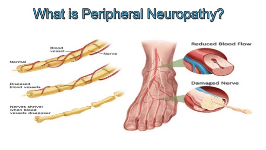 An explanation of Peripheral Neuropathy
